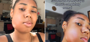 Internet Horrified by Woman’s Shocking Reaction After Wisdom Teeth Removal