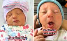 Mom Shares How Twin Got a ‘Crooked Jaw’ in the Womb