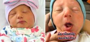 Mom Shares How Twin Got a ‘Crooked Jaw’ in the Womb