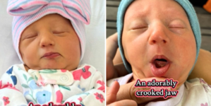 Mom Shares How Twin Got a ‘Crooked Jaw’ in the Womb