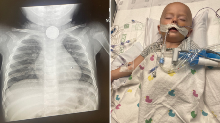 Parents Prepared to Say Goodbye After Toddler Swallows Button Battery