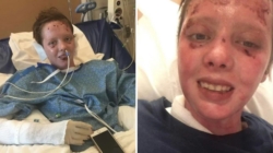 Gen Z Woman Survives Gas Explosion, Then She Shares Update 6 Years Later