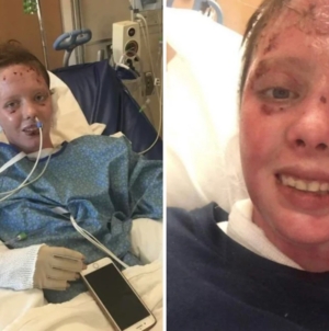 Gen Z Woman Survives Gas Explosion, Then She Shares Update 6 Years Later