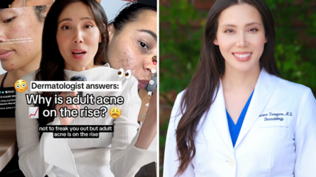 Adult Acne Is on the Rise—Here’s What You Need To Know