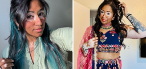 Woman With Vitiligo Since Childhood Starts Clinical Trial—Result Goes Viral