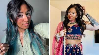 Woman With Vitiligo Since Childhood Starts Clinical Trial—Result Goes Viral