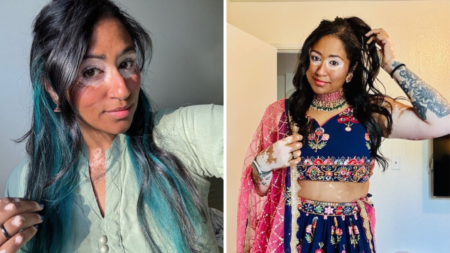 Woman With Vitiligo Since Childhood Starts Clinical Trial—Result Goes Viral