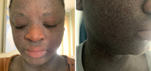 Woman Given Steroids as a Child—Now Faces Agonizing Condition