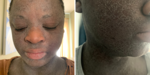 Woman Given Steroids as a Child—Now Faces Agonizing Condition