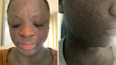 Woman Given Steroids as a Child—Now Faces Agonizing Condition