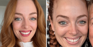 I Thought I Had a Pimple on My Nose, but It Changed My Life Forever